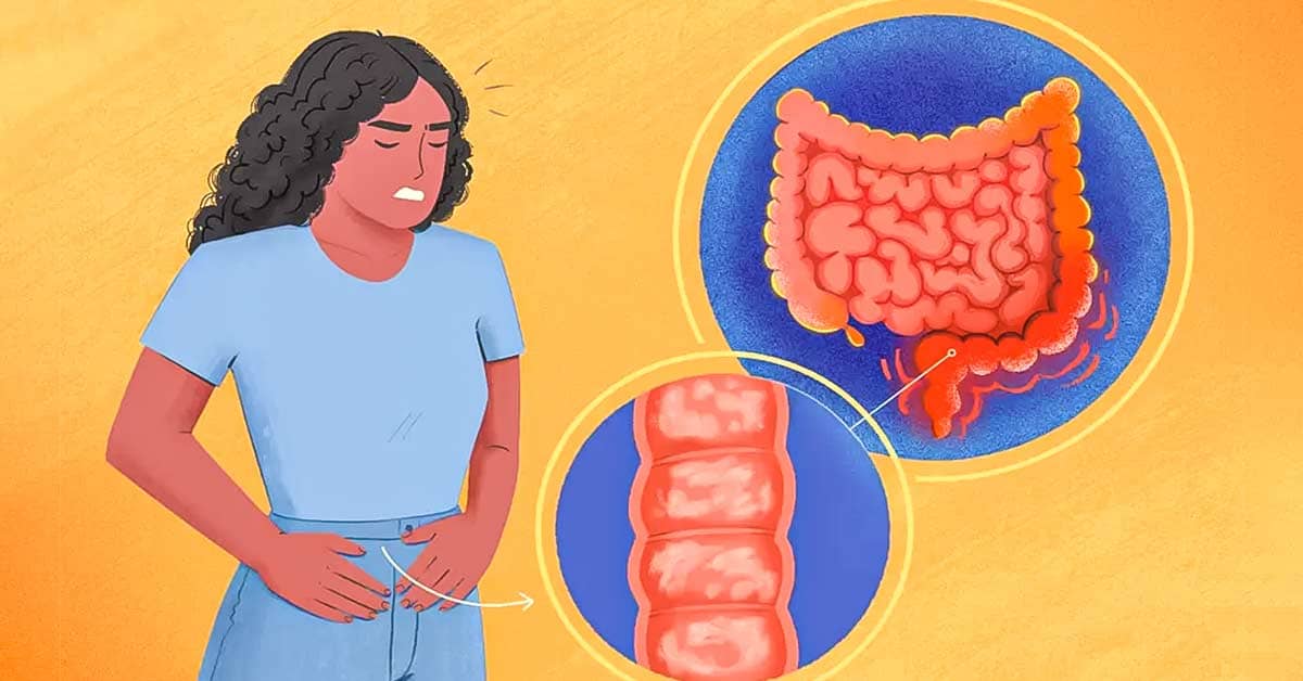 Not to be Ignored: Symptoms of Ulcerative Colitis