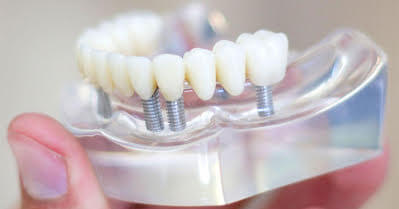 Seniors: Full Mouth Dental Implants For $99 Only