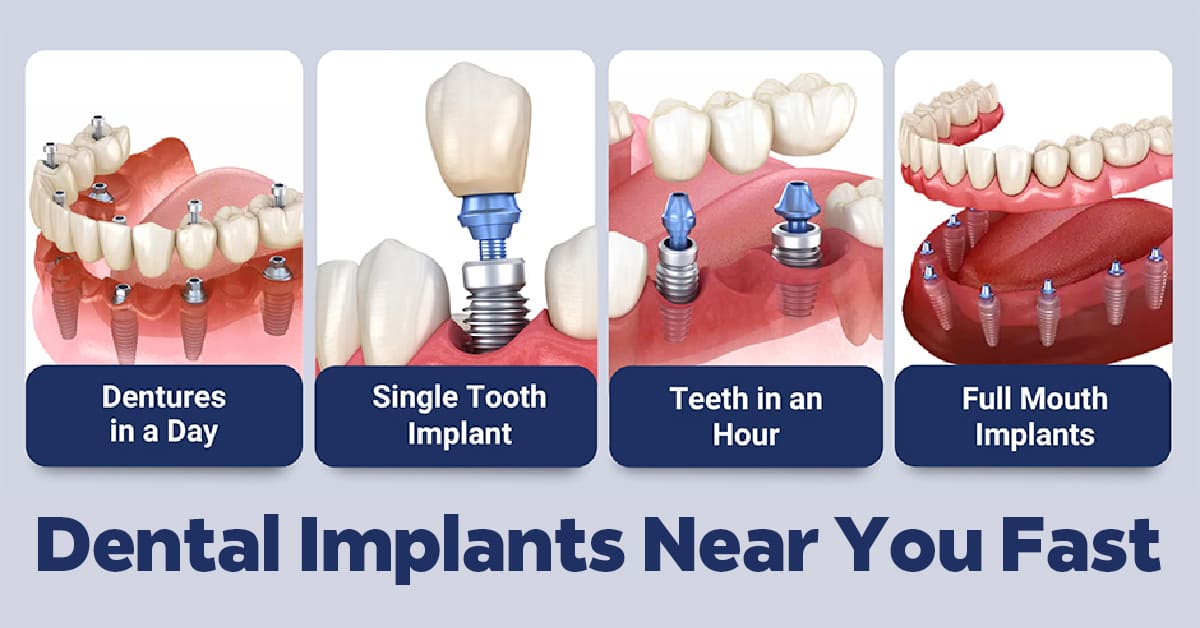 The Fastest Way To Get Dental Implant Near You - Teeth In One Day