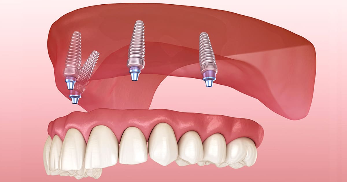 Find Affordable Dental Implants Near You (The Price Might Surprise You).