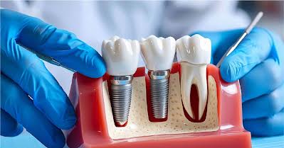 Super Deals: Choose Affordable Dental Implants Near Me-Only the lowest price