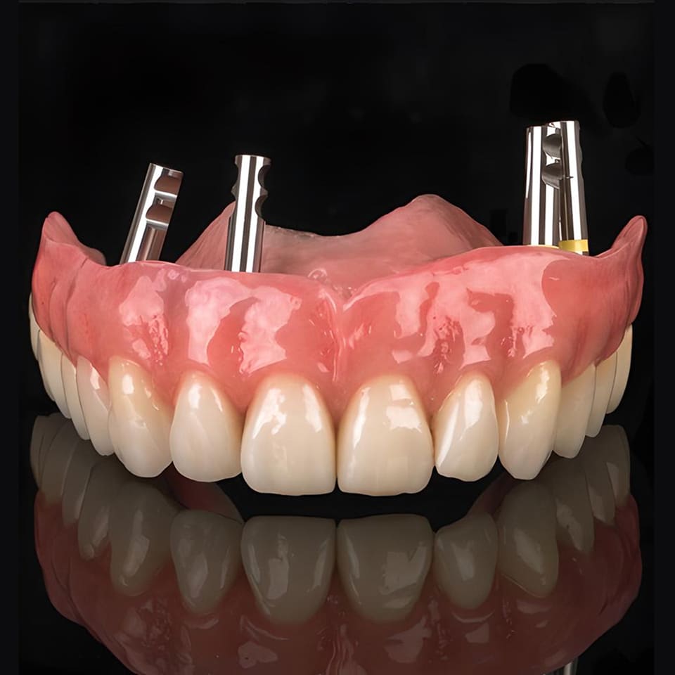 Seniors How To Find The Cheapest Full Mouth Dental Implants IHowList