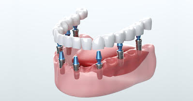 I Need Affordable Dental Implants Near Me: Find Cost-Effective Services