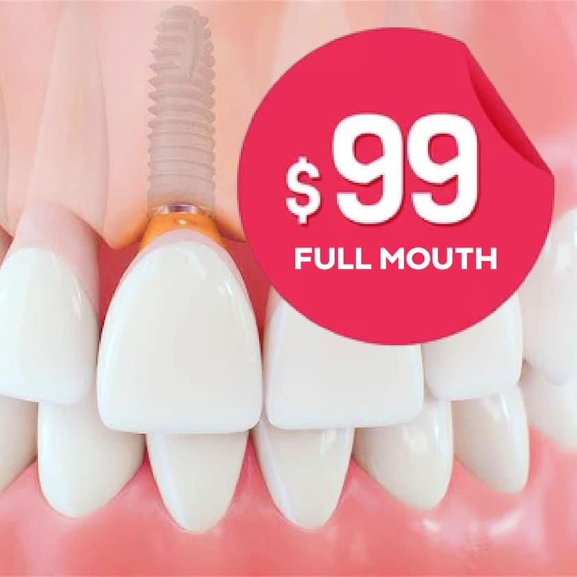 Seniors: Full Mouth Dental Implants For $99 Only